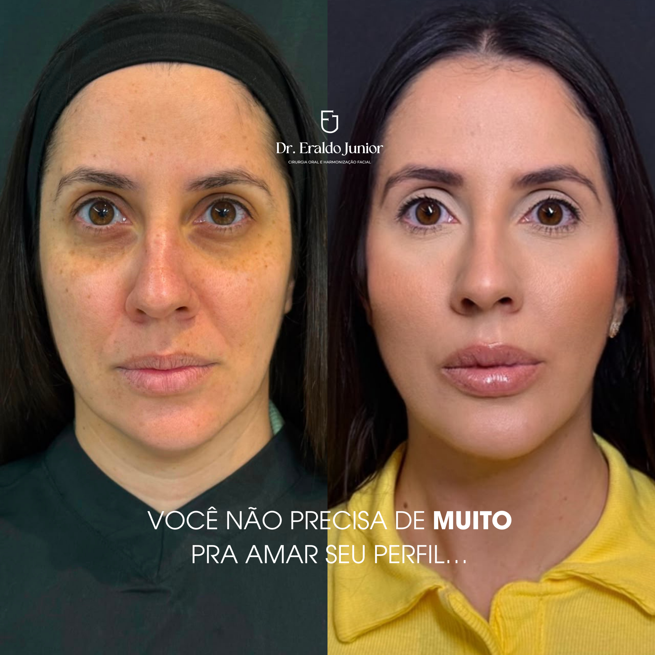FullFace resultado 1, Dr. Eraldo Junior Fortaleza CE