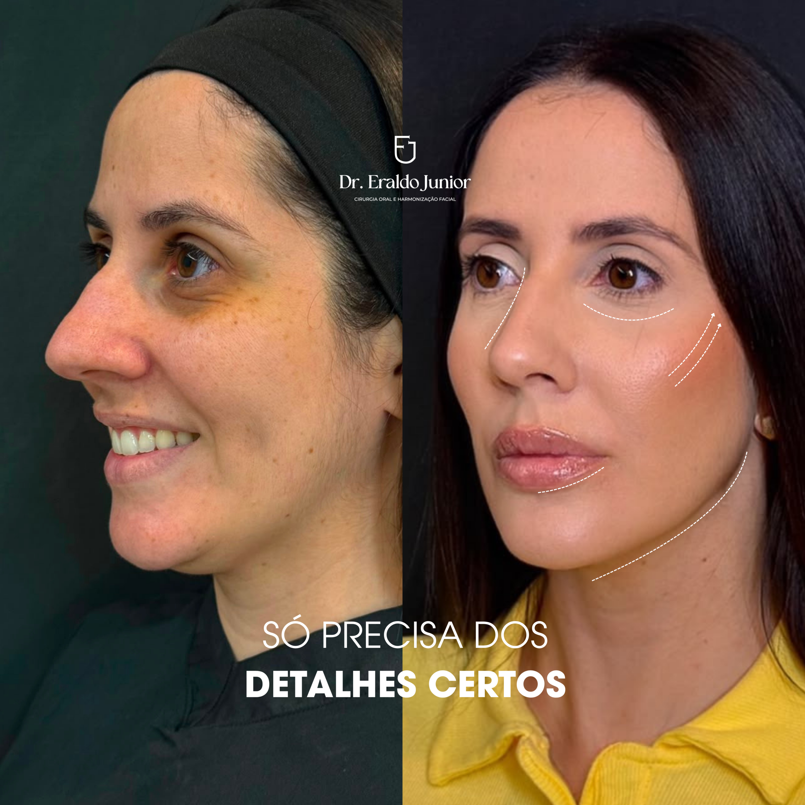 FullFace resultado 2, Dr. Eraldo Junior Fortaleza CE
