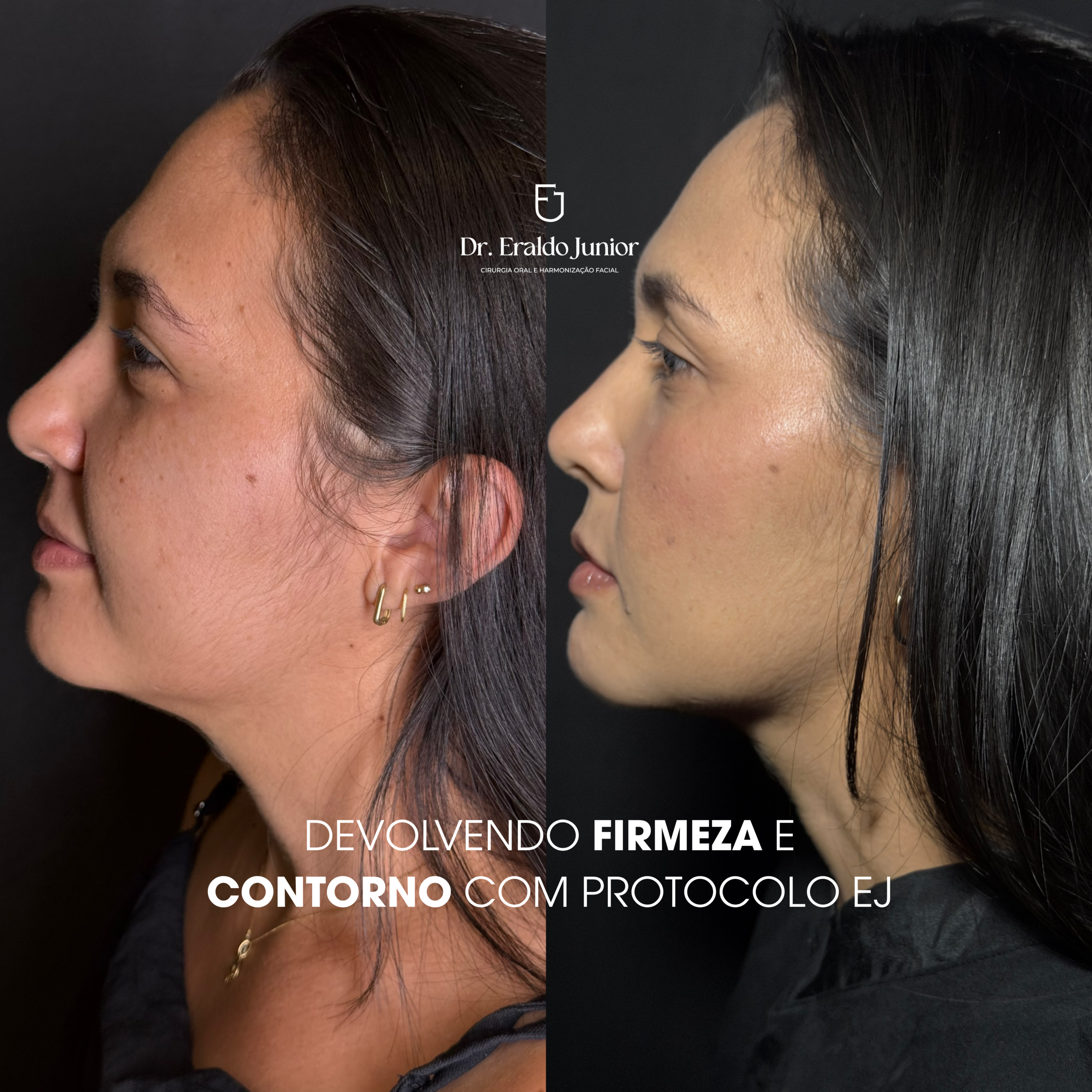Bioestimulador de Colágeno, Dr. Eraldo Junior Fortaleza CE