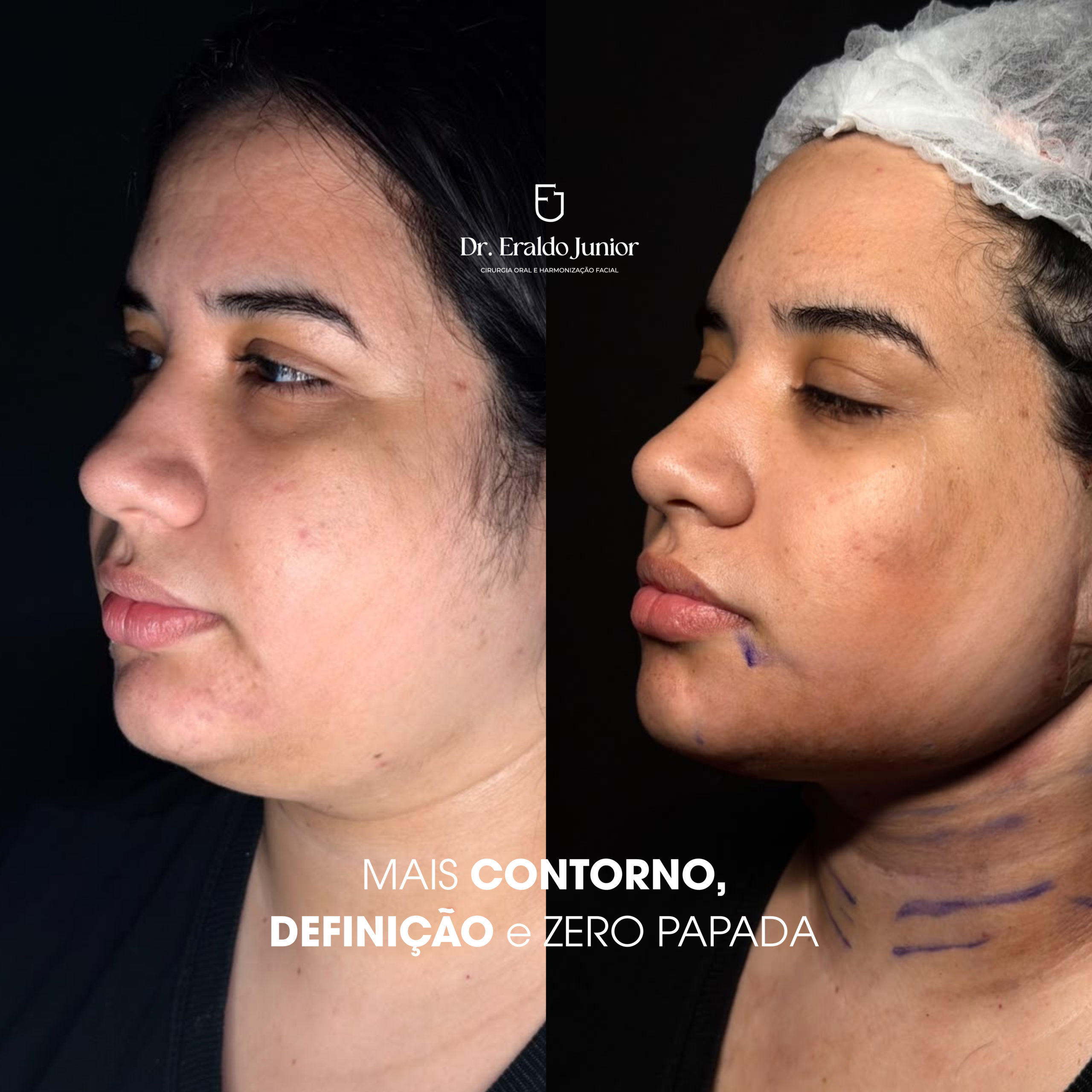 Resultado Neck Lift, Dr. Eraldo Junior Fortaleza CE
