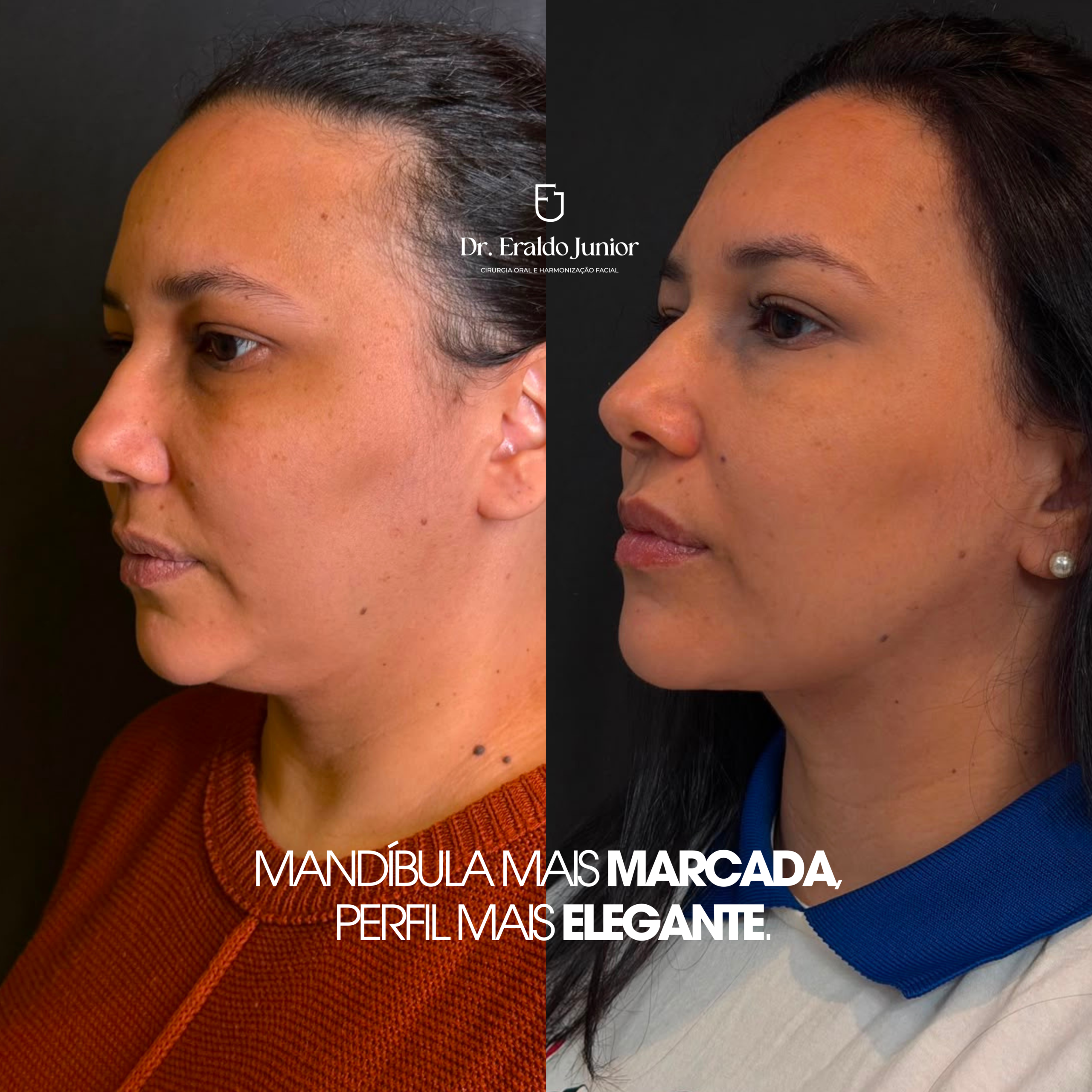 Lipo de Papada HD resultado 2, Dr. Eraldo Junior Fortaleza CE