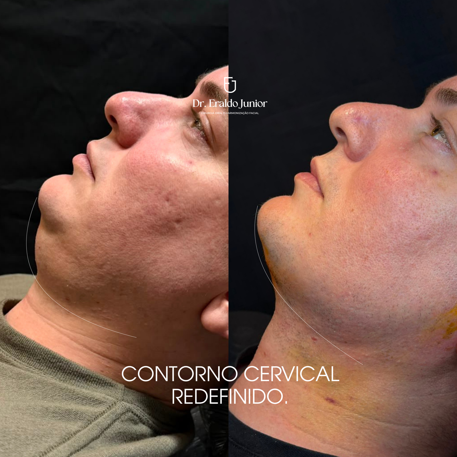 Resultado Harmonização Facial, Dr. Eraldo Junior Fortaleza CE